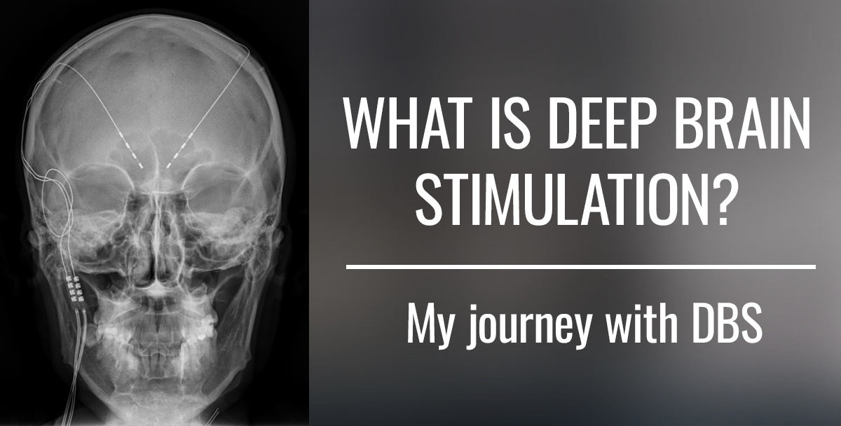 What is Deep Brain Stimulation (DBS)?