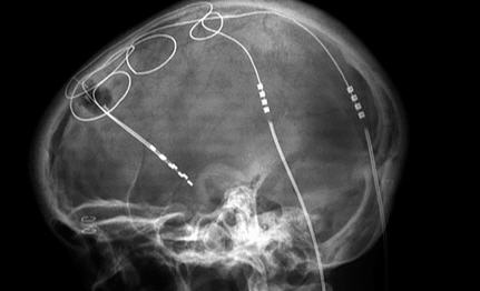 Deep Brain Stimulation (DBS) Implant Side View X-Ray