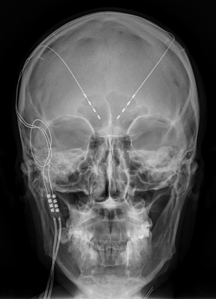 Deep Brain Stimulation (DBS) Implant Front View X-Ray